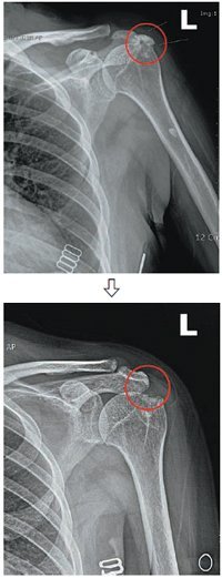 어깨 주변에 하얀 석회(붉은 원)가 엑스선 사진에서 보인다. 치료 뒤에 하얀 부분이 없어졌다.