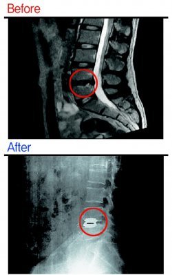 디스크 내장증으로 검게 보이던 척추(위에서 네번째)가 인공디스크 치환술을 받고 난 뒤 다시 하얗게 보인다. 사진 제공 굿스파인병원