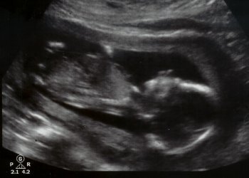아놀드 부부가 블로그에 올린 임신 16주차 때의 태아 초음파 사진. 이들은 \'심장도 뛰고 바깥에서 나는 소리도 들을 수 있다\'고 아기의 뱃속 성장 모습을 소개했다.(사진출처=birthornot.com)