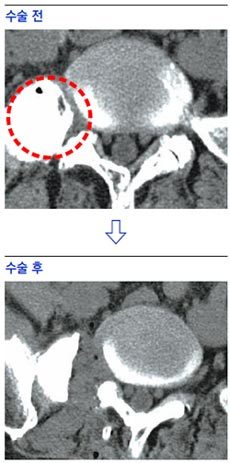 수술 전 우측 허리 뼈가 비대해지면서 추간공 부위 협착으로 인해 허리 신경이 눌려 있음. (위쪽 사진) 수술 후 비대했던 뼈를 제거해 눌렸던 신경이 풀린 사진. (아래 사진)