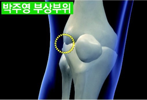 오른 무릎 대퇴골 외측 박리성 골연골염.