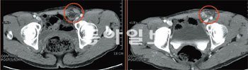 탈장 수술 전후 CT 사진. 장내용물이 고환쪽으로 내려온 장면(왼쪽)이 보인다. 복벽으로 삐져나온 장이 수술 이후 원래 상태로 돌아갔다.