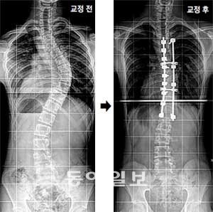 척추가 목부터 휘어진 척추측만증 환자의 X선 촬영 사진(왼쪽). 나사못과 강봉을 이용해 척추를 바로잡은 뒤 뼈 사이가 벌어지지 않도록 교정했다.동아일보 DB