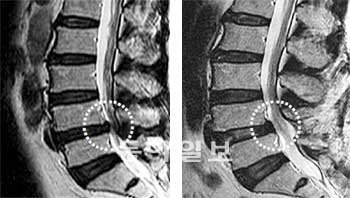 우측 아래에 척추관이 좁아져 있는 척추관협착증 자기공명영상(MRI) 촬영 사진(왼쪽), 수술 뒤 우측 아래의 척추관이 확장된 MRI 사진. 한림대 의대 제공