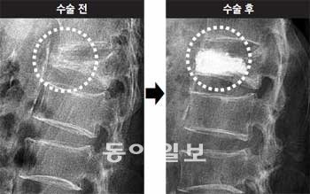 수술 전 뼈엉성증 때문에 발생한 척추 압박골절 X선 사진(왼쪽 원), 같은 환자의 골절부위에 의료용 특수시멘트(오른쪽 원)를 넣어 척추체 성형술을 시행한 뒤 척추뼈가 펴진 모습. 한림대의료원 제공