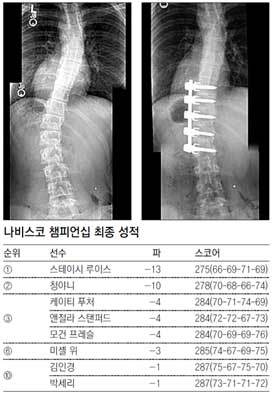 스테이시 루이스의 휘어 있는 척추(왼쪽)와 철심 5개를 박아
굽은 척추를 편 X선 사진. 스테이시 루이스 홈페이지