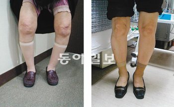 인공관절 수술 전(왼쪽)과 인공관절 수술 후