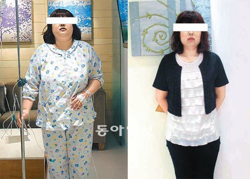 고도비만인 심모씨(31)는 수술 전(왼쪽) 체중이 100kg 이었지만 수술 6개월 뒤에 35kg를 줄여 정상체중((65kg)으로 돌아왔다. 서울슬림외과 제공