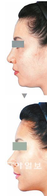 미스코 수술법으로 코성형수술을 받은 환자의 수술전(위쪽) 후(아래쪽) 모습. 강남성형외과 제공
