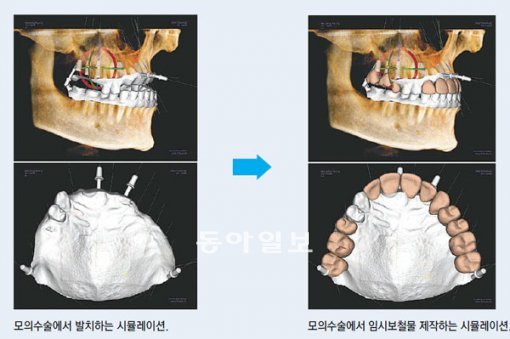 모의수술에서 발치하는 시뮬레이션(왼쪽). 모의수술에서 임시보철물 제작하는 시뮬레이션.