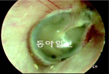 정상 고막을 귀 외부에서 찍은 모습. 가운데 타원형 부분이 고막이다. 반투명으로 회백색을 띤다. 중이를 보호하고 음파의 진동을 전해주는 역할을 한다. 하나이비인후과 제공