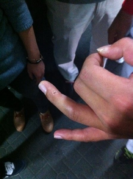 이승호 손가락 투혼. 스포츠동아DB