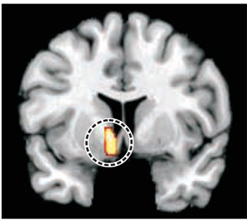 연구팀이 fMRI로 촬영한 조사대상 중학생들의 뇌. 주당 평균 9시간 이상 게임을 한 그
룹의 보상계 중추인 줄무늬체 영역(점선으로 표시된 부분)이 9시간 미만 그룹보다 더 크게 나타났다. 사진 출처 병진정신분석저널