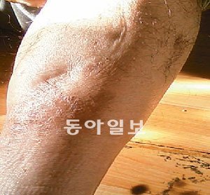 충북 청원군 S안식원의 한 장애인이 폭행으로 인해 생긴 듯한 다리 흉터를 보여주고 있다. 보건복지부 제공