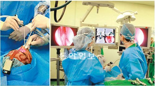국립중앙의료원 뇌·두개기저부 내시경 수술팀이 최첨단 내시경수술시스템을 이용해 뇌하수체 종양을 제거하고 있다. 신경외과와 이비인후과 협진으로 코를 통해 수술을 한다. 국립중앙의료원 제공