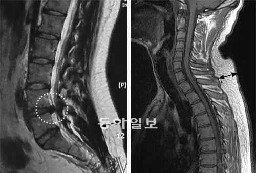 강 의원이 공개한 허리-목 MRI 사진 강용석 의원이 박원순 서울시장의 아들 박주신 씨의 자기공명영상(MRI) 사진이라며 공개한 자료. 왼쪽 사진을 보면 허리 뒤편의 두꺼운 지방층이 흰색으로 나타난다. 원 안은 추간판(디스크)이 탈출한 부분. 오른쪽 목 사진에도 목 뒤쪽으로 지방이 겹쳐 있다. 의사들은 이런 점을 들어 사진의 주인공이 90kg 이상의 거구일 것으로 추정한다. 강용석 의원 제공