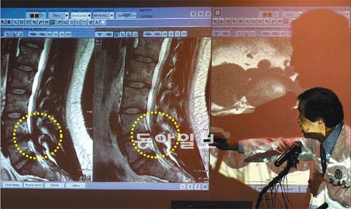 “4-5요추 사이 디스크 돌출 모습 일치” 22일 연세대 세브란스병원 6층 브리핑실에서 윤도흠 신경외과 교수가 박원순 서울시장의 아들 주신씨가 이날 촬영한 허리디스크 MRI 사진(화면 왼쪽)과 지난해 12월 9일 찍은 사진(화면 오른쪽)을 비교해 보여주며 동일 인물의 사진이라고 설명하고 있다. 점선 안이 제4요추와 제5요추 사이 디스크가 돌출돼 있는 모습이다. 장승윤 기자 tomato99@donga.com