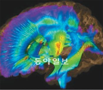 뇌 속에 있는 신경통로를 3차원(3D)으로 관찰한 사진. 노란색과 빨간색 부분이 비정상적으로 자란 백질 부분이다. 생후 6개월 된 유아에게서 발견되면 1년 뒤 자폐증에 걸린다고 진단할 수 있다. 노스캐롤라이나대 제공