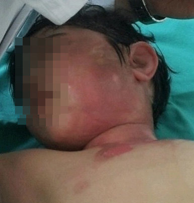 화상 입은 아이 사진. 포털 게시판에서 글과 사진은 삭제된 상태다.