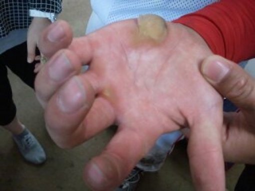 안치홍의 손바닥. 스포츠동아DB