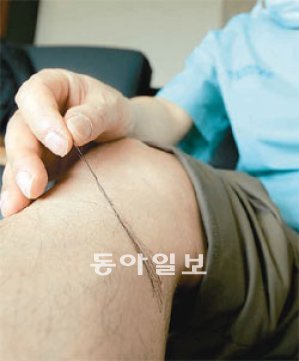 “제 다리에 털 심었죠” 김정철 교수가 1992년 자신의 머리카락 20여 가닥을 오른쪽 다리에 옮겨 심은 것으로 20년이 지난 지금도 튼튼하게 자라고 있다. 이것이 세계 최초로 개발한 모낭군 이식술의 출발이다.