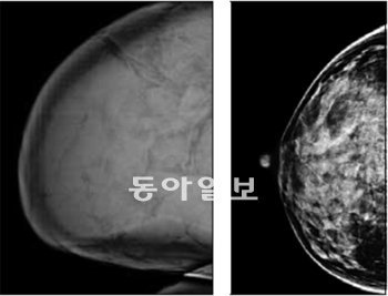 거대유방증으로 5.4kg까지 커진 A 씨의 왼쪽 유방(왼쪽 사진)과 평균 크기(250g)인 일반인의 유방 자기공명영상(MRI) 사진. 건국대병원 유방암센터 제공