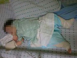 ▲어린이집 화상사고