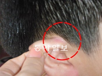 지난달 20일 인천 서구 A초교에서 담임 교사가 소란을 피운다는 이유로 2학년 남학생의 귀를 잡아당겨 찢은 사고가 발생했다. 치료를 받은 이후 사진에도 상처가 남아있다. 피해 학부모 제공