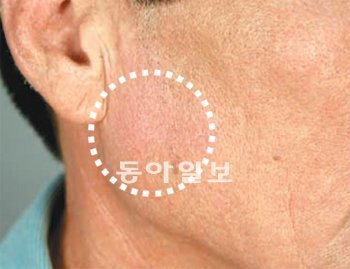 피부가 붉게 변하는 홍반에 비늘이 생긴 모습. 고려대 안암병원 제공