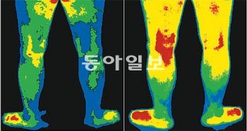 왼쪽처럼 양쪽 다리가 파랗게 보이던 적외선체열검사 소견이 시술 후 에서 보듯 따뜻한 색깔로 호전되었다. 다리의 혈액순환 개선과 하지저림 증상이 없어졌다는 증거. 참포도나무병원 제공