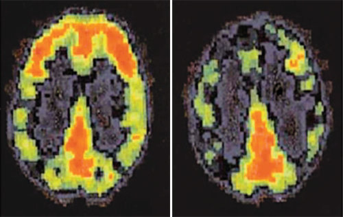 외부 자극에 노출된 일반 사람의 뇌(왼쪽)와 흉악범죄자의 뇌(오른쪽)를 양전자단층촬영(PET)한 결과 전두엽 부분(뇌의 앞부분·사진 위쪽)의 활성화 정도가 큰 차이를 보였다. 흥분조절과 행동억제 기능을 담당하는 전두엽이 손상될 경우 죄책감이나 동정심이 결여되는 증상이 나타난다. 미국 서던캘리포니아대 에이드리언 레인 교수 연구 논문에서 발췌