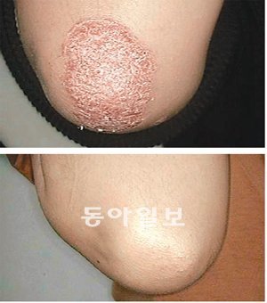 20대 후반 여성의 팔꿈치에 나타난 건선 질환 한방치료 전후 사진. 건선 질환은 피부세포가 비정상적으로 증식돼서 각질 등이 생기는 것이다. 이 환자는 한방치료를 6개월 정도 받은 뒤 건선 질환이 사라졌다. 고운누리한의원 제공