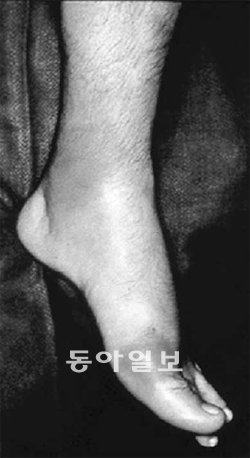 통풍에 걸리면 엄지발가락과 발목이 벌겋게 부어오르고 열이 나면서 심한 통증을 겪는다. 삼성서울병원 제공