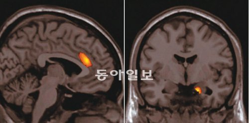 자유주의자와 보수주의자는 근본적으로 뇌 구조에 차이가 있음을 보여주는 사진. 영국 연구진은 자기공명영상(MRI)으로 뇌를 촬영해 자유주의자일수록 ‘전측대상피질’이(왼쪽 사진), 보수적일수록 오른쪽 편도체가 크다는 것을 밝혀냈다. 전측대상피질은 낯선 상황에서 갈등을 처리해 행동을 결정하는 영역이고 편도체는 위험을 감지해 두려움에 반응하는 영역이다. 가나이 료타 박사 제공