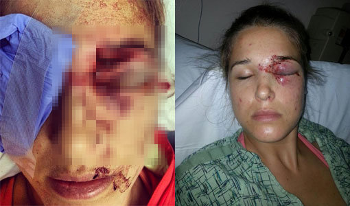 보드 밀러의 골프공에 맞아 큰 부상을 입은 모건 밀러.