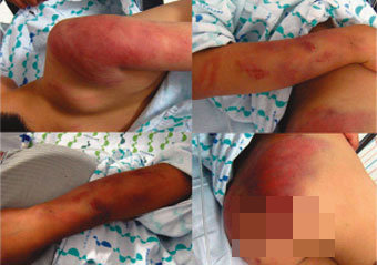 신체 학대를 당한 아이의 상처.