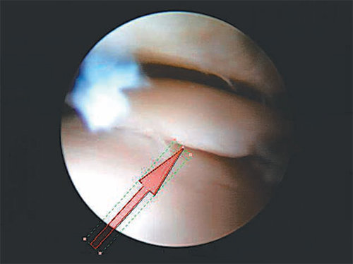 내시경을 통해 발목 연골 수술을 하면 안전하고 합병증이 적다. 내시경으로 찢어진 연골 부위를 정확히 살펴보고 있는 모습. 연세견우정형외과 제공