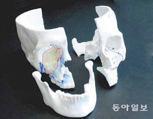 환자의 두개골을 컴퓨터단층촬영(CT)한 뒤 3D 프린터를 이용해 모형물을 만들고 이를 바탕으로 제작한 인공 뼈 구조물. 삼성서울병원 제공