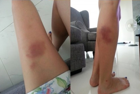 리얼리티를 강조한 예능프로그램들의 경쟁 속에 출연자들의 부상이 잇따르고 있다. 사진은 MBC ‘스플래시’에 출연한 아이비의 다리와 팔에 멍이 든 모습. 사진출처｜아이비 블로그