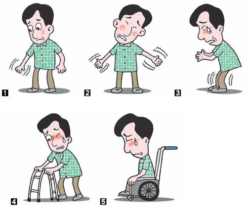 파킨슨병 진행 5단계 ▶ [1] 마비 등의 증상이 팔이나 다리 한쪽에만 발생 [2] 증상이 양쪽 팔다리에 생기지만 균형감은 유지 [3] 양쪽 팔다리에 증상이 심해 걷기가 어려워짐 [4] 증상 심하지만 보조기구 이용해 활동은 가능 [5] 혼자서 움직일 수 없어 휠체어에 전적으로 의존