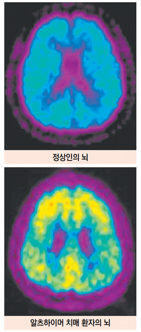 치매 환자의 뇌에서 밝게 빛나는 부분이 베타아밀로이드가 침착된 부분이다. 베타아밀로이드는 치매 여부를 판단하는 마커로 사용된다. 서울대병원 치매클리닉