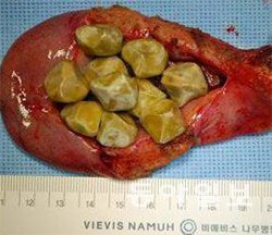 담석증 환자의 담낭에서 발견된 돌멩이 같은 담석들의 모습. 비에비스나무병원 제공