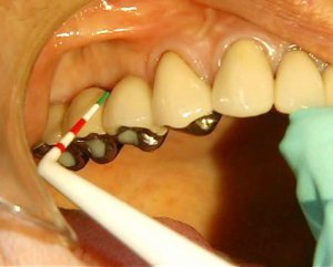 치주질환의 진행 정도는 가는 탐침(probing)을 치주낭에 깊이를 측정하는 방법으로 진단한다. 치주낭이 깊을수록 병증이 심각한 것이다. 서울대 치과병원 제공