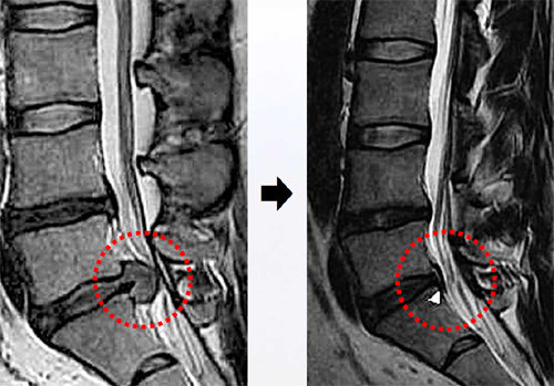 2012년 10월 19일 촬영된 자기공명영상(MRI)사진(왼쪽). 요추 5번과 천추 1번 사이에서 후종 인대를 뚫고 탈출된 
디스크가 관찰된다. 2013년 12월 12일 촬영된 MRI(오른쪽). 탈출된 디스크 크기가 감소됐다. 자생한방병원 제공