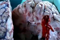 뇌출혈로 혈관이 터진 뇌를 보여 주는 호주 금연광고. 유튜브 캡처