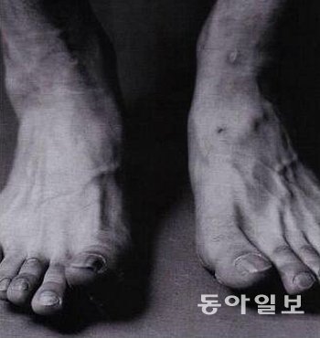 휘어진 발로… 박지성은 조금만 뛰어도 쉽게 피로와 통증을 느끼는 평발을 지녔으면서도 누구보다 많이 뛰었다. 거칠어진 그의 발은 그의 성실성과 정신력의 상징이었다. 동아일보DB