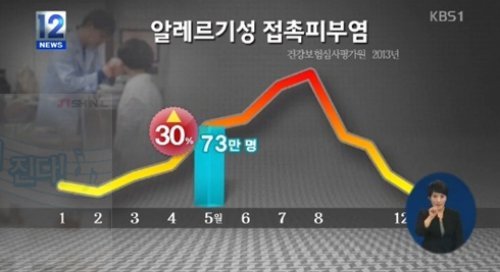 알레르기성 접촉피부염, KBS1 뉴스 화면 촬영