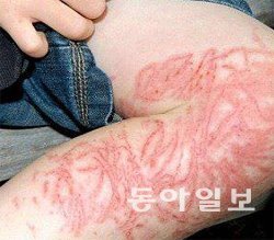 해파리에 쏘이면 피부가 붉게 착색되는 것은 물론이고 호흡곤란, 어지러움 등의 증상이 나타날 수 있다. 동아일보DB