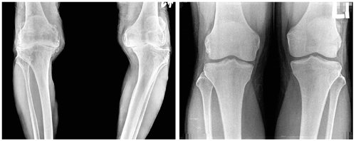 왼쪽은 치료가 필요한 말기 관절염 무릎 X선 사진. 오른쪽은 정상 무릎 X선 사진.