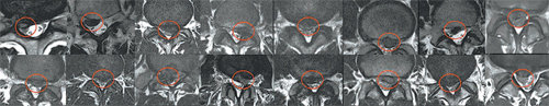 평균 나이 37.25세(20∼50대 남자 10명, 여자 6명) 16명의 FIMS 시술전 디스크탈출증 MRI 사진.